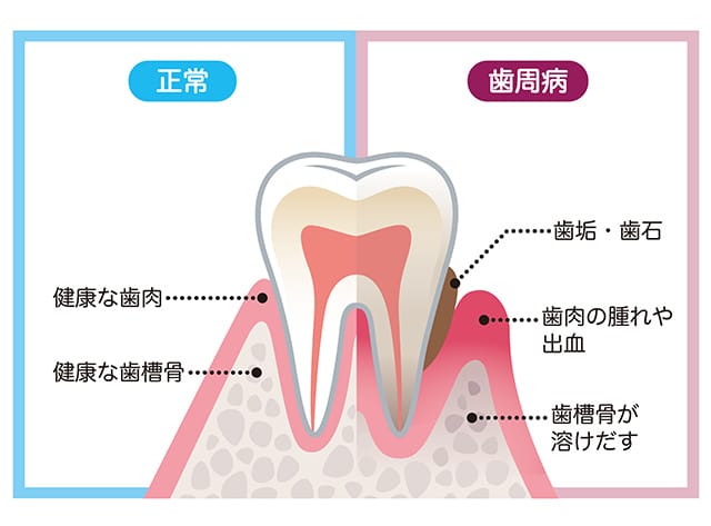 予防歯科 虫歯を作らず未然に防ぐ さいじょう歯科の予防診療